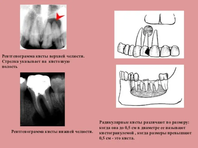 Рентгенограмма кисты верхней челюсти. Стрелка указывает на кистозную полость Радикулярные кисты различают