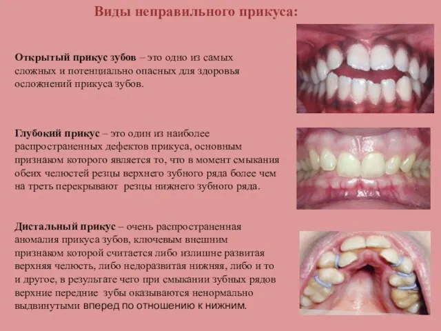 Виды неправильного прикуса: Глубокий прикус – это один из наиболее распространенных дефектов