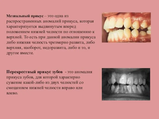 Мезиальный прикус – это одна из распространенных аномалий прикуса, которая характеризуется выдвинутым