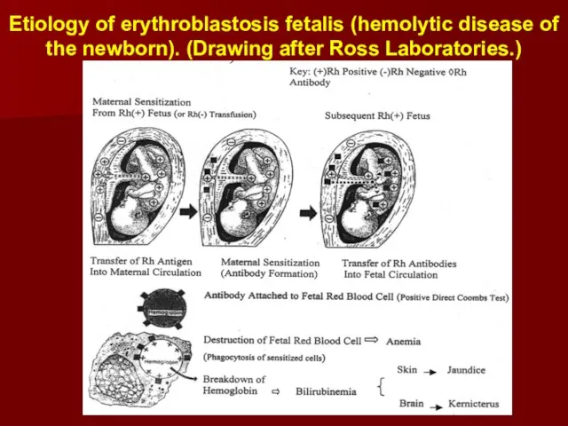 Etiology of erythroblastosis fetalis (hemolytic disease of the newborn). (Drawing after Ross Laboratories.)