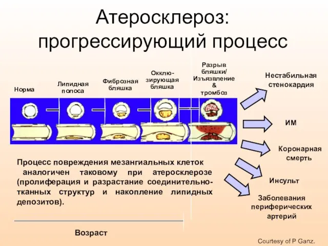 Норма Липидная полоса Фиброзная бляшка Окклю-зирующая бляшка Разрыв бляшки/ Изъязвление & тромбоз