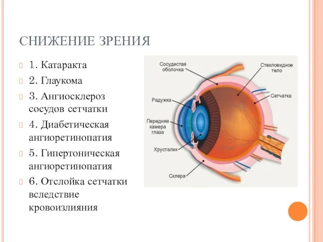 СНИЖЕНИЕ ЗРЕНИЯ 1. Катаракта 2. Глаукома 3. Ангиосклероз сосудов сетчатки 4. Диабетическая