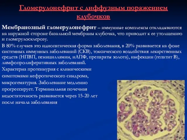 Гломерулонефрит с диффузным поражением клубочков Мембранозный гломерулонефрит – иммунные комплексы откладываются на