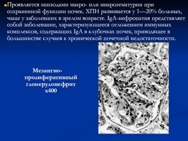 Мезангио-пролиферативный гломерулонефрит х400 Проявляется эпизодами макро- или микрогематурии при сохраненной функции почек.