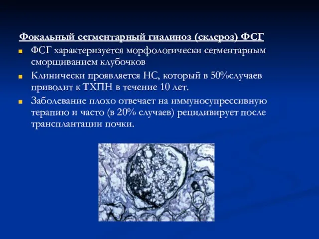 Фокальный сегментарный гиалиноз (склероз) ФСГ ФСГ характеризуется морфологически сегментарным сморщиванием клубочков Клинически