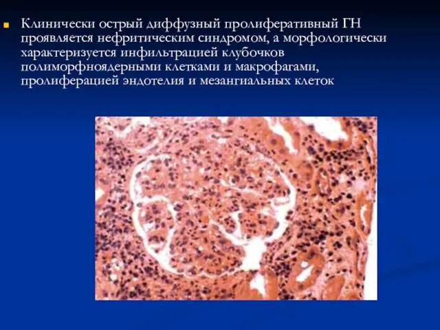 Клинически острый диффузный пролиферативный ГН проявляется нефритическим синдромом, а морфологически характеризуется инфильтрацией