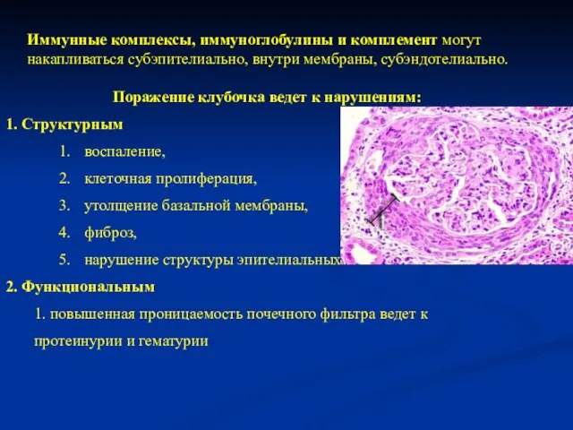 Иммунные комплексы, иммуноглобулины и комплемент могут накапливаться субэпителиально, внутри мембраны, субэндотелиально. Поражение