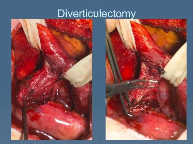 Diverticulectomy