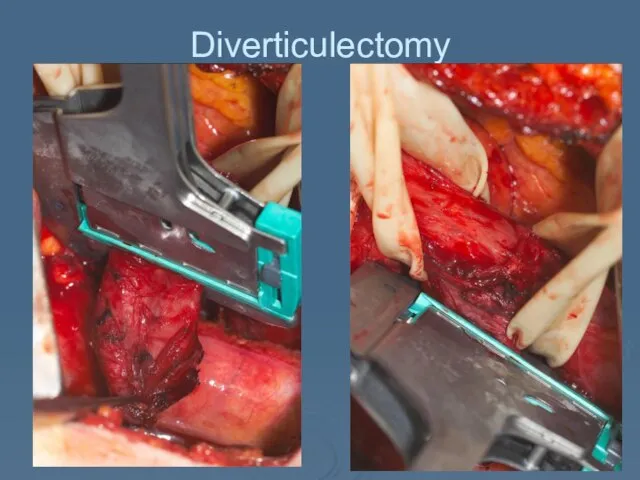 Diverticulectomy