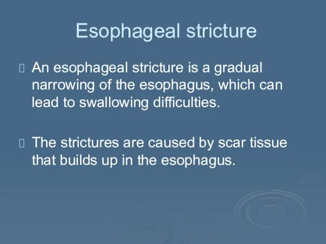 Esophageal stricture An esophageal stricture is a gradual narrowing of the esophagus,