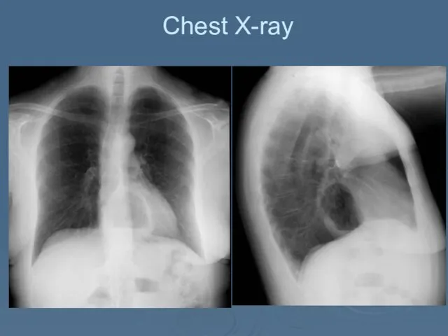 Chest X-ray