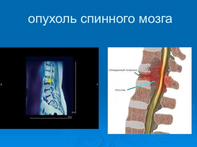 опухоль спинного мозга