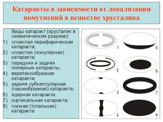 Катаракты в зависимости от локализации помутнений в веществе хрусталика Виды катаракт (хрусталик