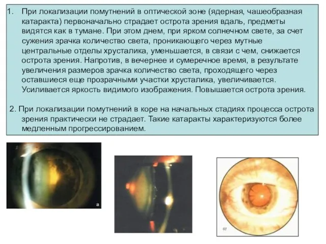 При локализации помутнений в оптической зоне (ядерная, чашеобразная катаракта) первоначально страдает острота