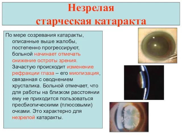 Незрелая старческая катаракта По мере созревания катаракты, описанные выше жалобы, постепенно прогрессируют,