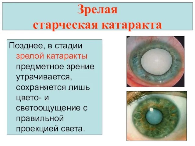 Зрелая старческая катаракта Позднее, в стадии зрелой катаракты предметное зрение утрачивается, сохраняется