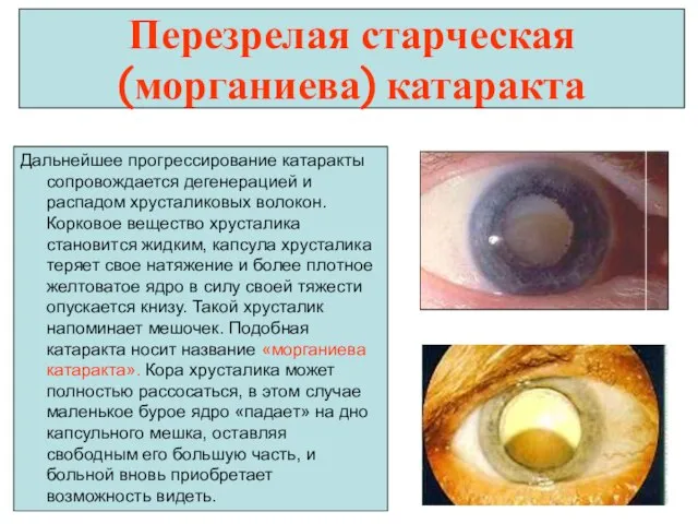 Перезрелая старческая (морганиева) катаракта Дальнейшее прогрессирование катаракты сопровождается дегенерацией и распадом хрусталиковых