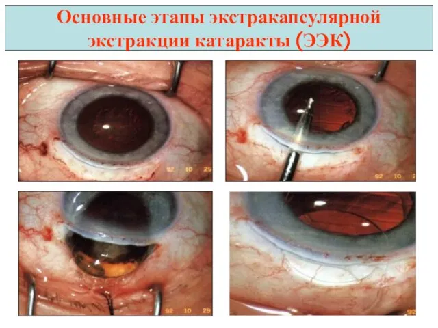 Основные этапы экстракапсулярной экстракции катаракты (ЭЭК)