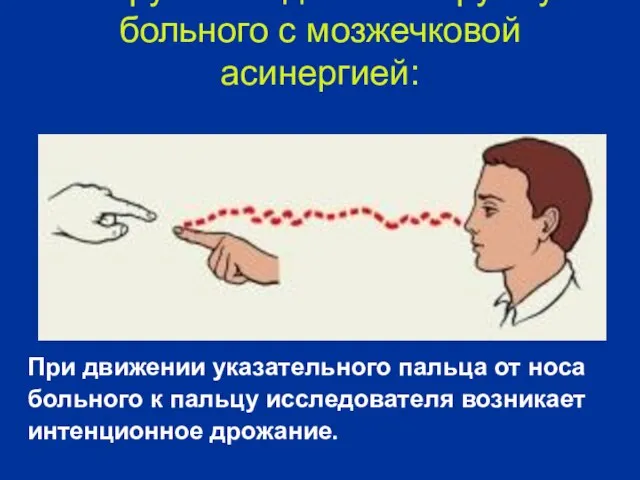 Нарушение движений руки у больного с мозжечковой асинергией: При движении указательного пальца