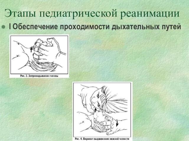 Этапы педиатрической реанимации I Обеспечение проходимости дыхательных путей