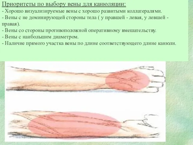 Приоритеты по выбору вены для канюляции: - Хорошо визуализируемые вены с хорошо