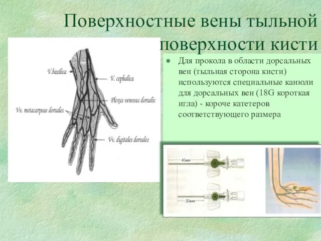 Для прокола в области дорсальных вен (тыльная сторона кисти) используются специальные канюли