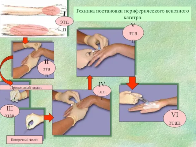 Техника постановки периферического венозного катетра Поперечный захват Продольный захват III этап I