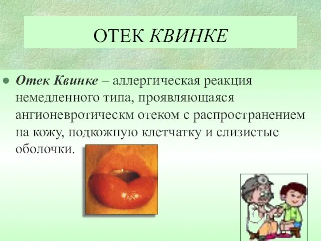 ОТЕК КВИНКЕ Отек Квинке – аллергическая реакция немедленного типа, проявляющаяся ангионевротическм отеком