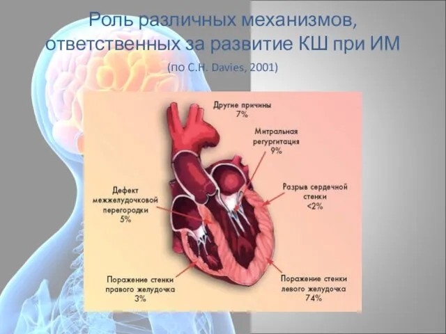 Роль различных механизмов, ответственных за развитие КШ при ИМ (по C.H. Davies, 2001)