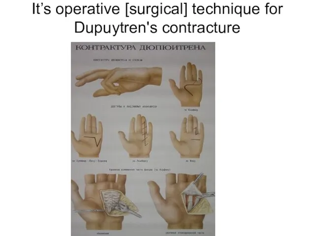 It’s operative [surgical] technique for Dupuytren's contracture