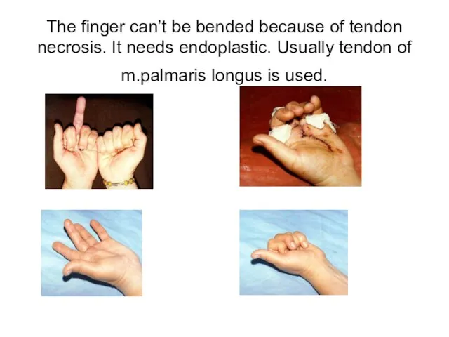 The finger can’t be bended because of tendon necrosis. It needs endoplastic.