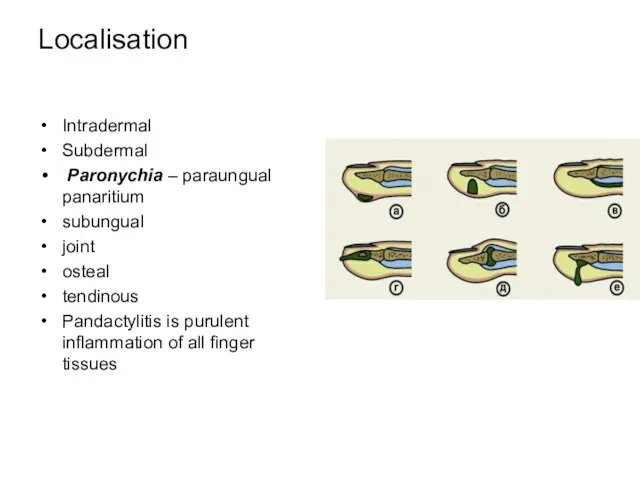 Localisation Intradermal Subdermal Paronychia – paraungual panaritium subungual joint osteal tendinous Pandactylitis