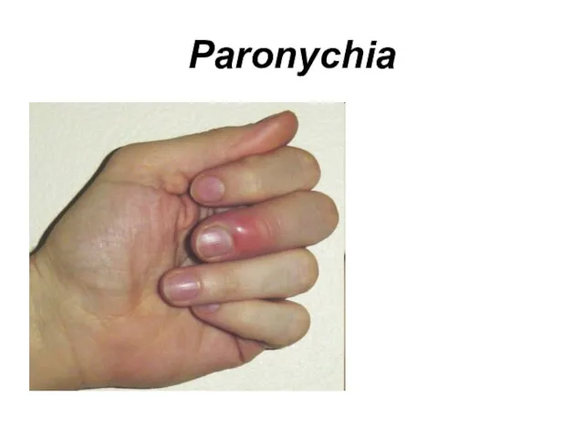 Paronychia