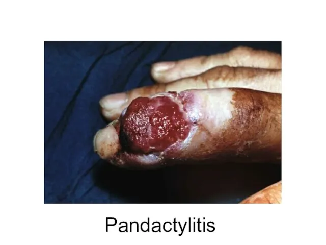 Pandactylitis