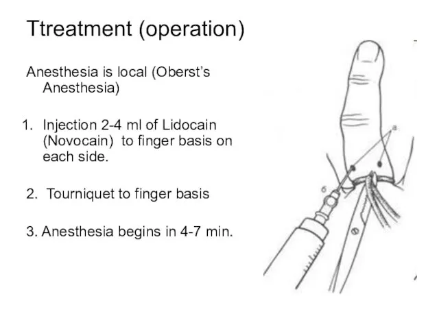 Ttreatment (operation) Anesthesia is local (Oberst’s Anesthesia) Injection 2-4 ml of Lidocain