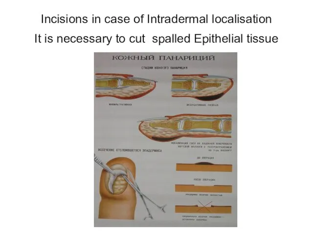 Incisions in case of Intradermal localisation It is necessary to cut spalled Epithelial tissue