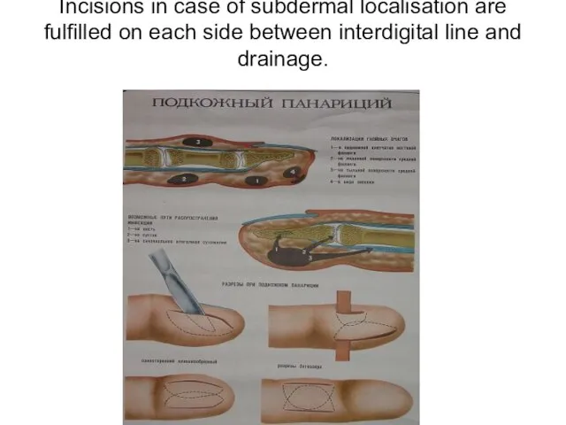 Incisions in case of subdermal localisation are fulfilled on each side between interdigital line and drainage.