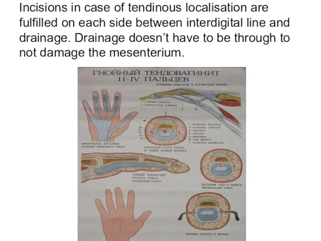 Incisions in case of tendinous localisation are fulfilled on each side between