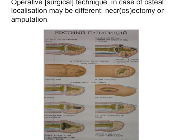 Operative [surgical] technique in case of osteal localisation may be different: necr(os)ectomy or amputation.