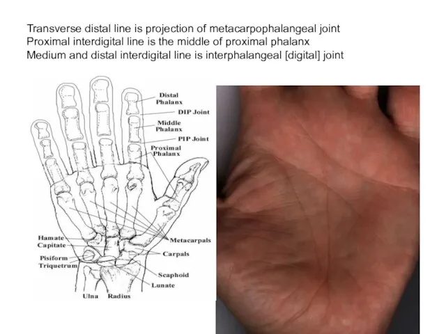 Transverse distal line is projection of metacarpophalangeal joint Proximal interdigital line is