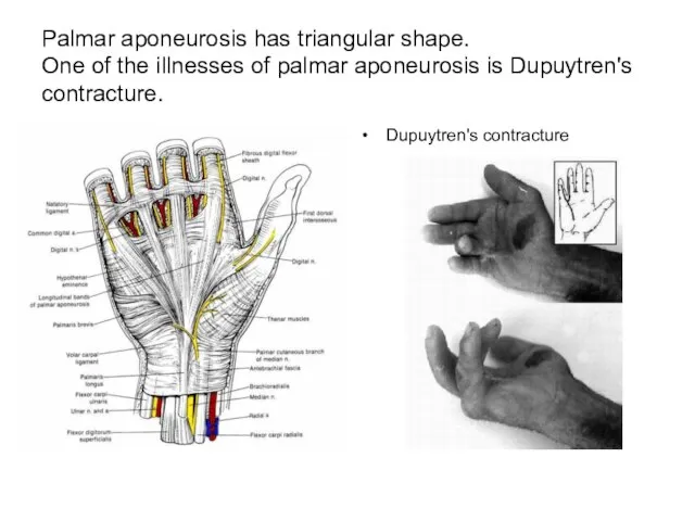 Palmar aponeurosis has triangular shape. One of the illnesses of palmar aponeurosis