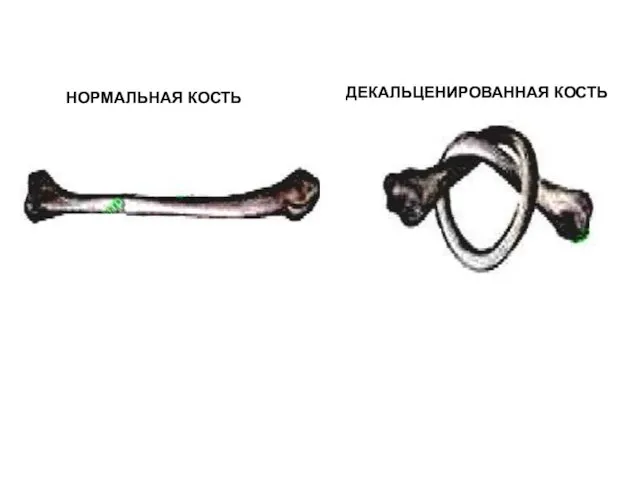 ДЕКАЛЬЦЕНИРОВАННАЯ КОСТЬ НОРМАЛЬНАЯ КОСТЬ