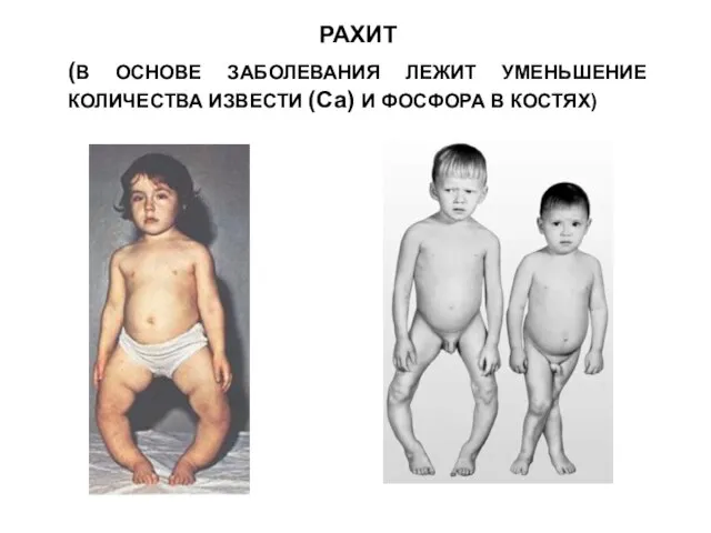 РАХИТ (В ОСНОВЕ ЗАБОЛЕВАНИЯ ЛЕЖИТ УМЕНЬШЕНИЕ КОЛИЧЕСТВА ИЗВЕСТИ (Са) И ФОСФОРА В КОСТЯХ)