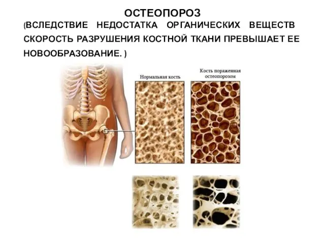 ОСТЕОПОРОЗ (ВСЛЕДСТВИЕ НЕДОСТАТКА ОРГАНИЧЕСКИХ ВЕЩЕСТВ СКОРОСТЬ РАЗРУШЕНИЯ КОСТНОЙ ТКАНИ ПРЕВЫШАЕТ ЕЕ НОВООБРАЗОВАНИЕ. )