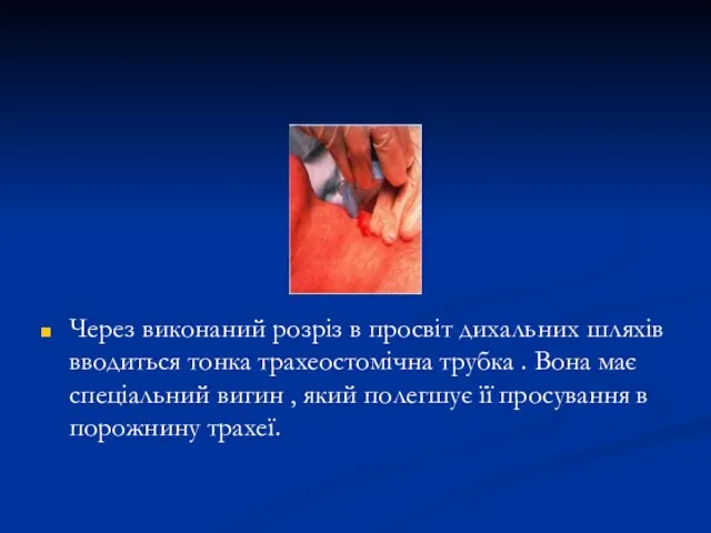 Через виконаний розріз в просвіт дихальних шляхів вводиться тонка трахеостомічна трубка .