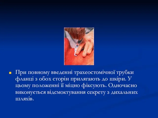 При повному введенні трахеостомічної трубки фланці з обох сторін прилягають до шкіри.