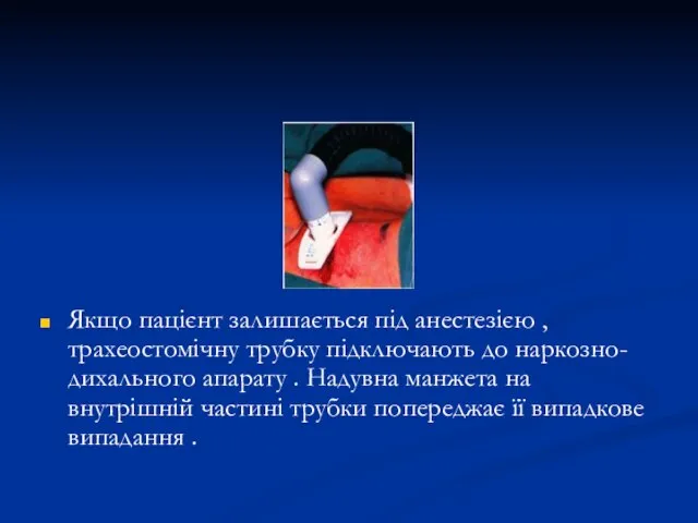 Якщо пацієнт залишається під анестезією , трахеостомічну трубку підключають до наркозно- дихального