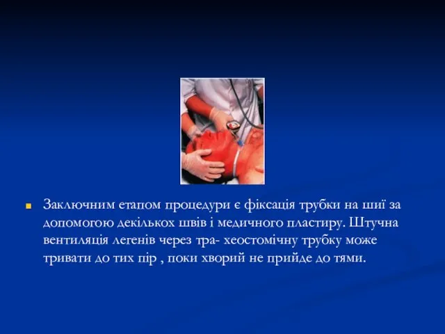 Заключним етапом процедури є фіксація трубки на шиї за допомогою декількох швів