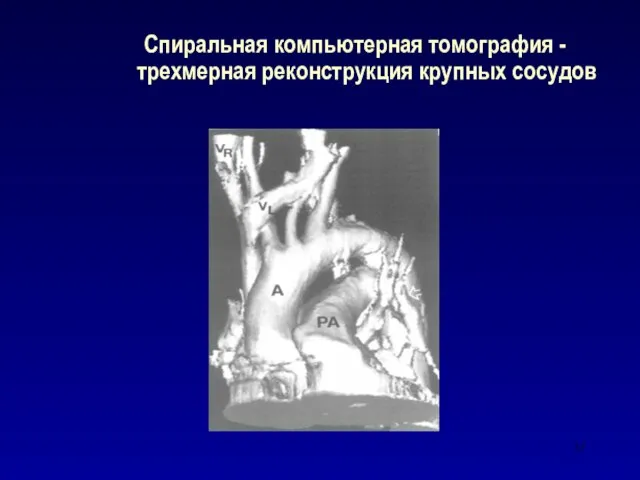 Спиральная компьютерная томография - трехмерная реконструкция крупных сосудов