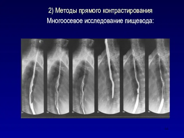 2) Методы прямого контрастирования Многоосевое исследование пищевода: